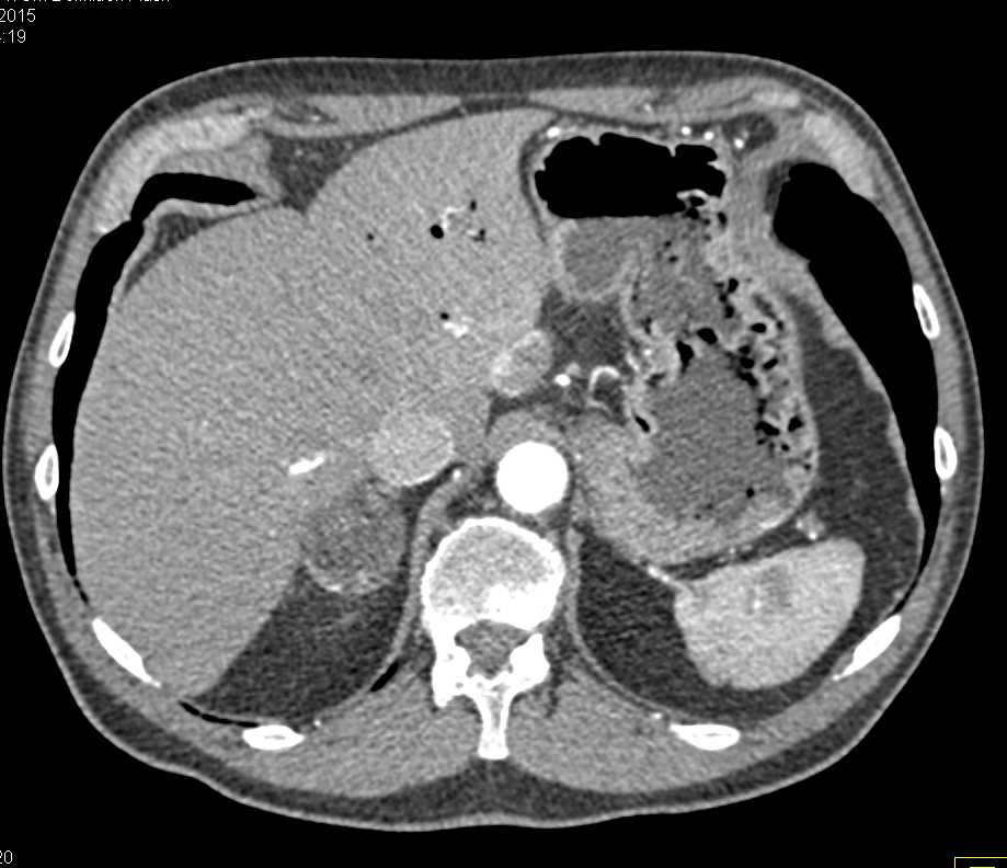 Incidental Right Adrenal Adenoma in a Patient with Pancreatic Cancer - CTisus CT Scan