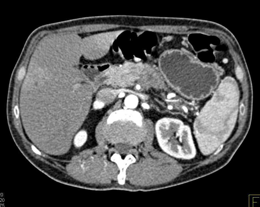 Leak from Bladder Base Following Prostatectomy - CTisus CT Scan