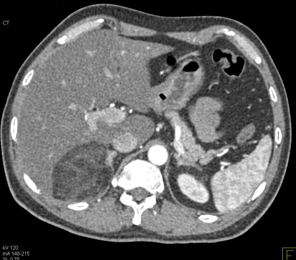 Right Adrenal Myelolipoma - CTisus CT Scan