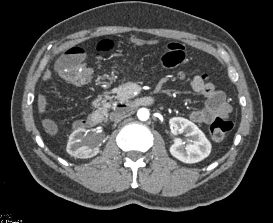 Carcinoid Tumor in the Root of the Mesentery - CTisus CT Scan