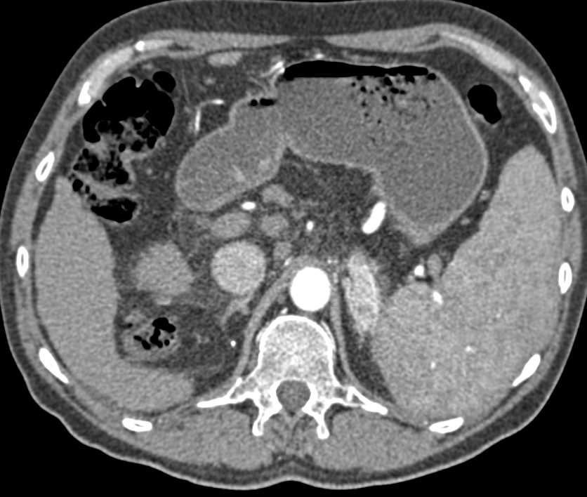 Renal Cell Carcinoma Metastatic to the Adrenal Glands and Liver - CTisus CT Scan