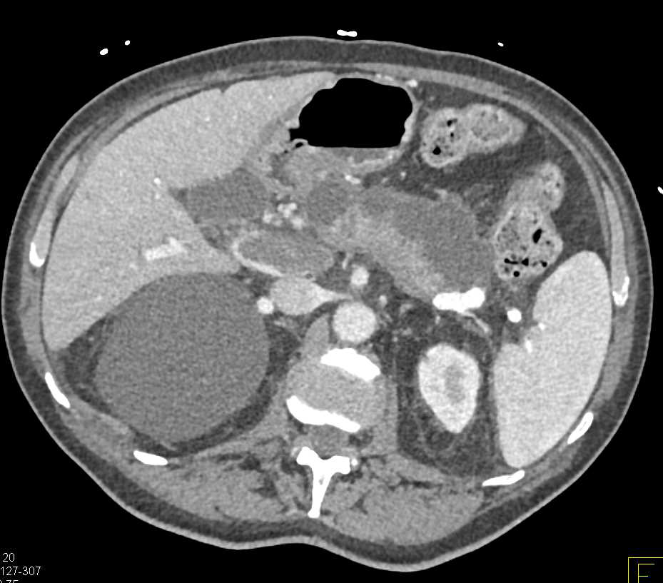 Incidental Adrenal Cyst in Patient with Invasive Pancreatic Cancer - CTisus CT Scan