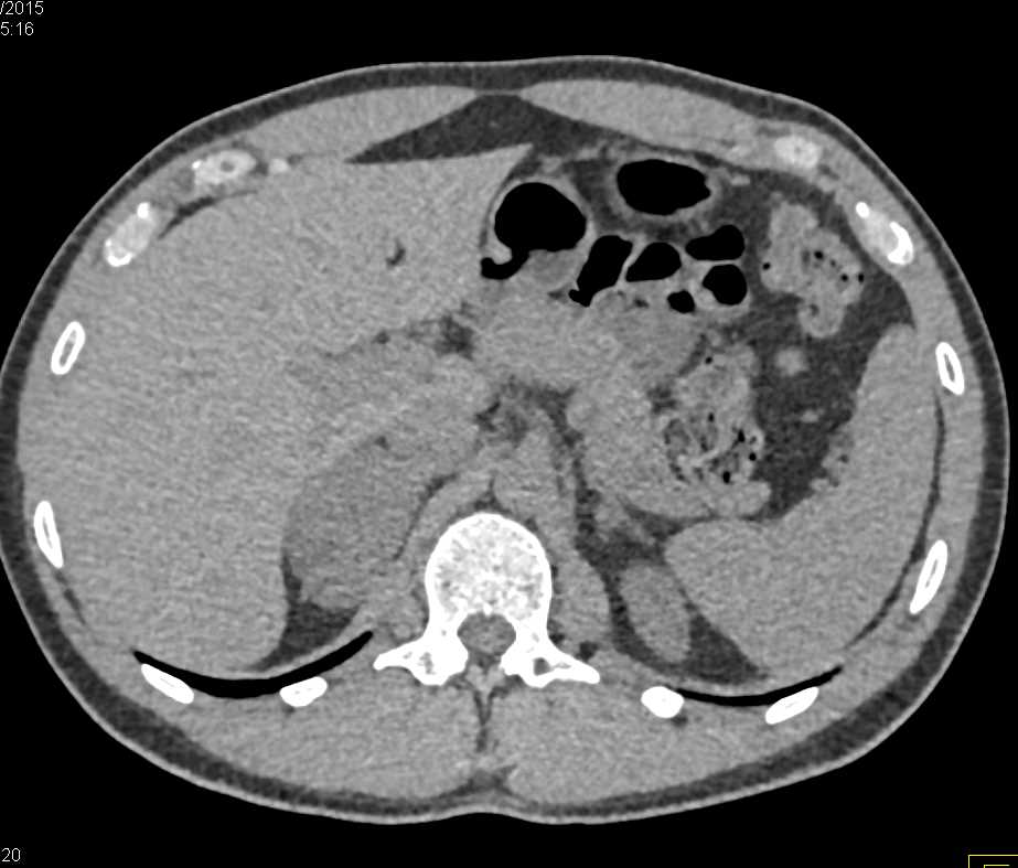 Fat Poor Right Adrenal Myelolipoma - CTisus CT Scan