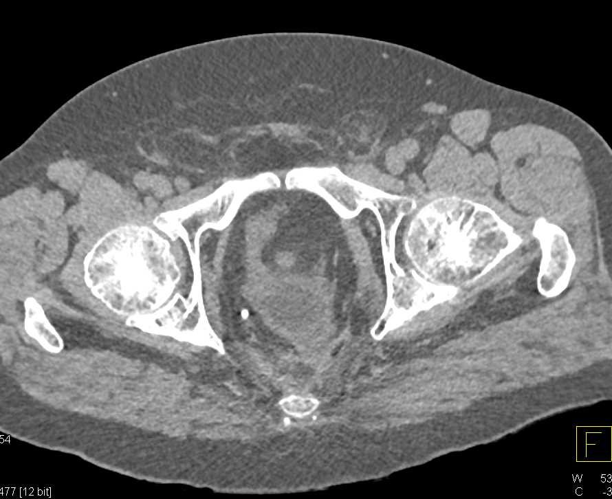 Leak from Urethra Bladder Junction - CTisus CT Scan