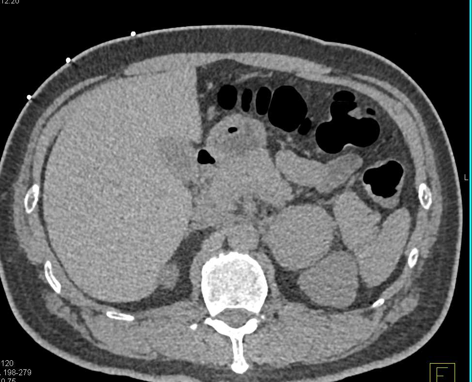 Pheochromocytoma Left Adrenal Gland - CTisus CT Scan