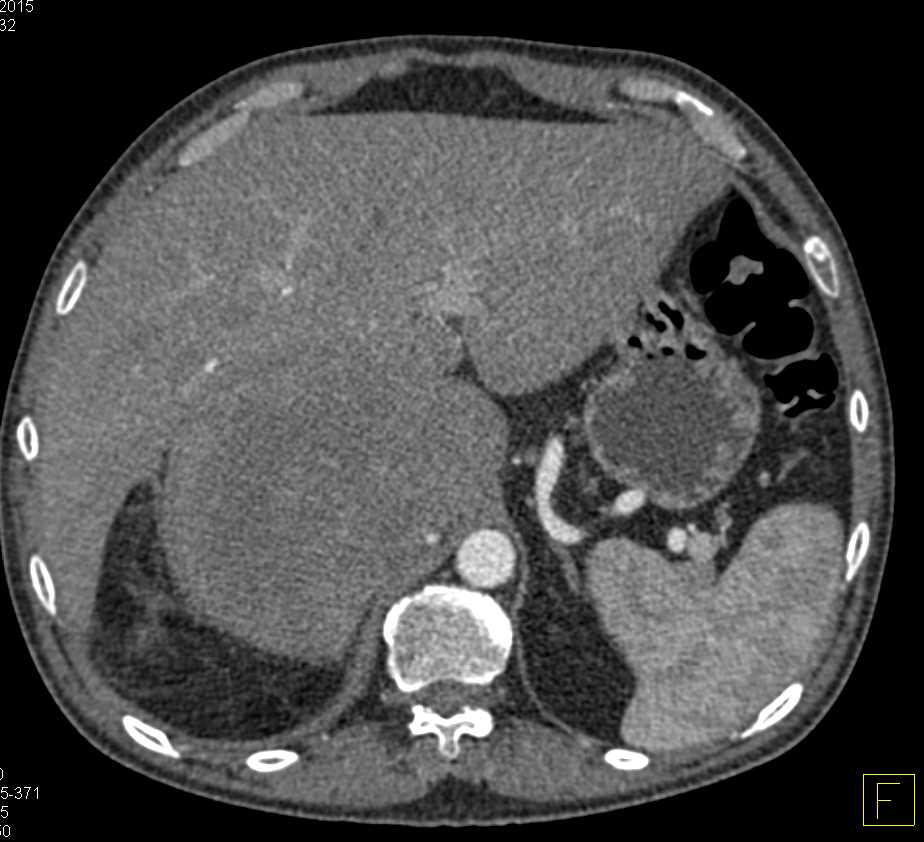Primary Adrenal Carcinoma - CTisus CT Scan