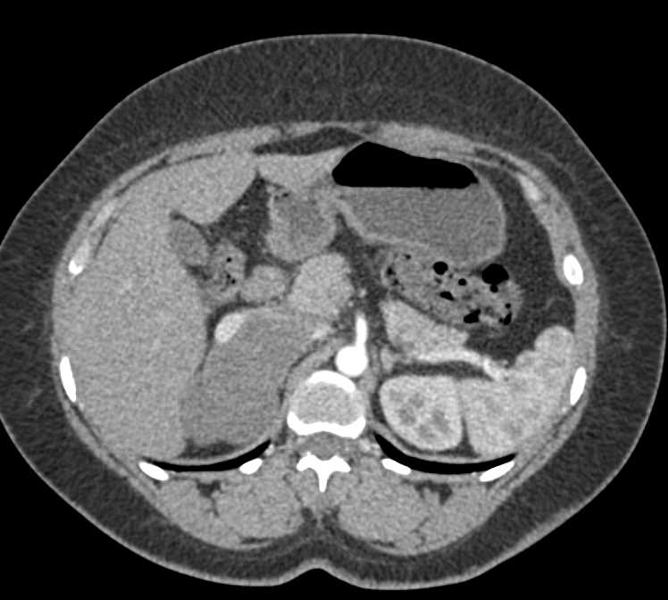 Adrenal Lymphoma - CTisus CT Scan