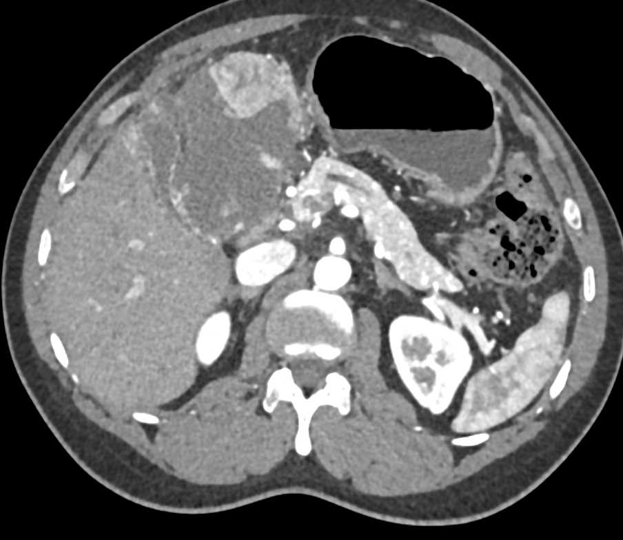 Hepatocellular Carcinoma (Hepatoma) with Neovascularity - CTisus CT Scan