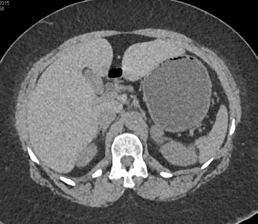 Pheochromocytoma Left Adrenal Gland - CTisus CT Scan
