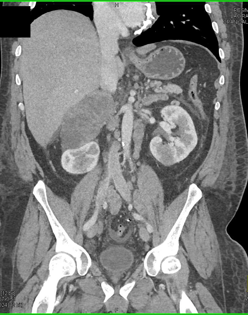 Metastases to the Right Adrenal Gland - CTisus CT Scan