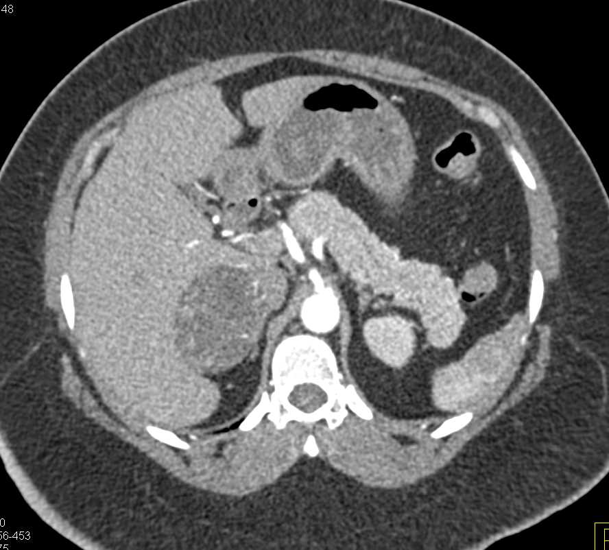 Adrenal Adenoma - CTisus CT Scan