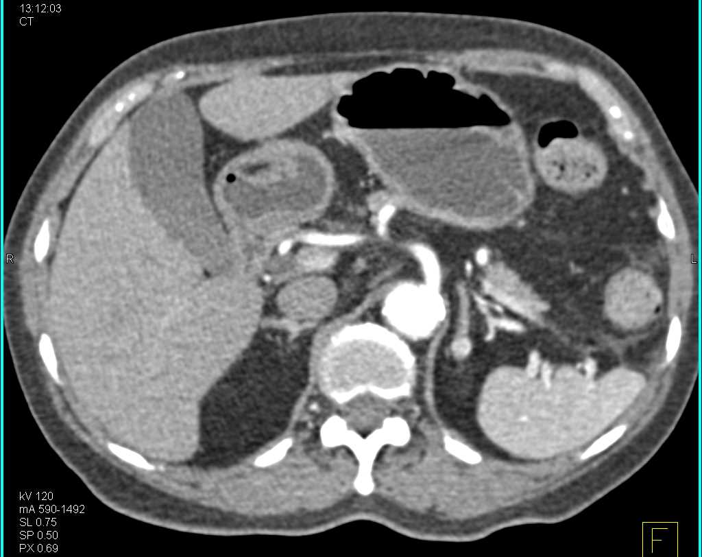 1cm Pheochromocytoma Left Adrenal Gland - CTisus CT Scan