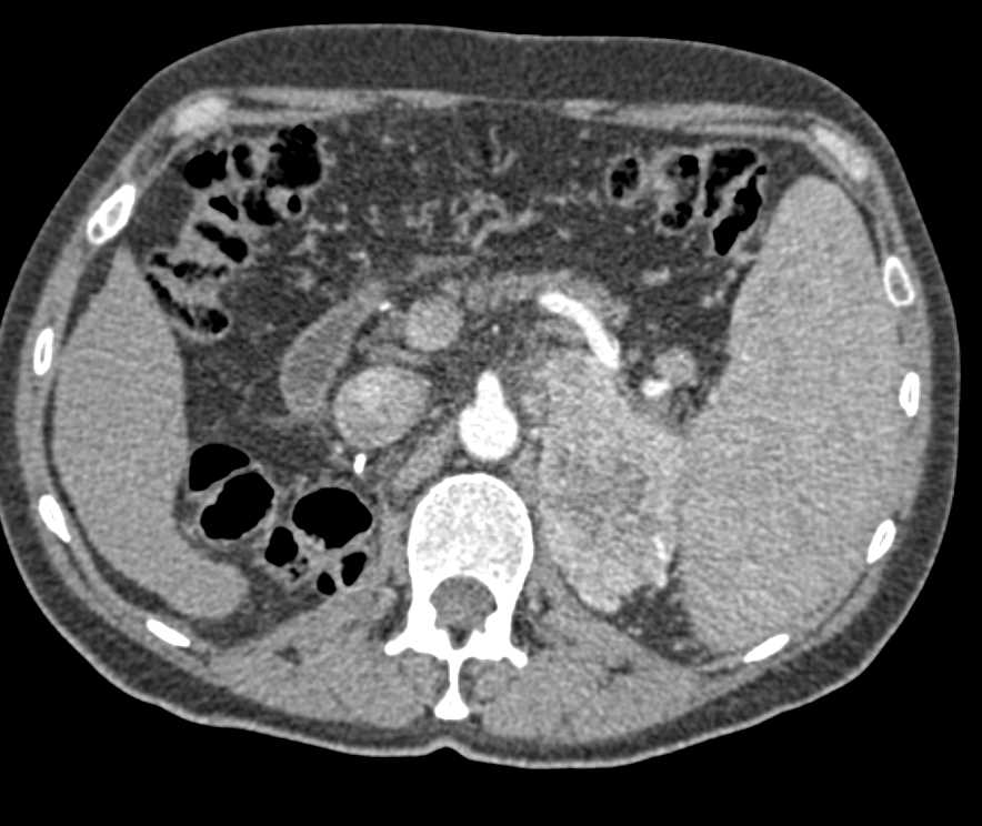 Recurrent Renal Cell Carcinoma to Contralateral Adrenal Gland - CTisus CT Scan