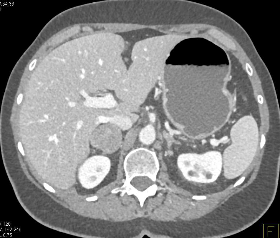 Adrenal Adenoma - CTisus CT Scan