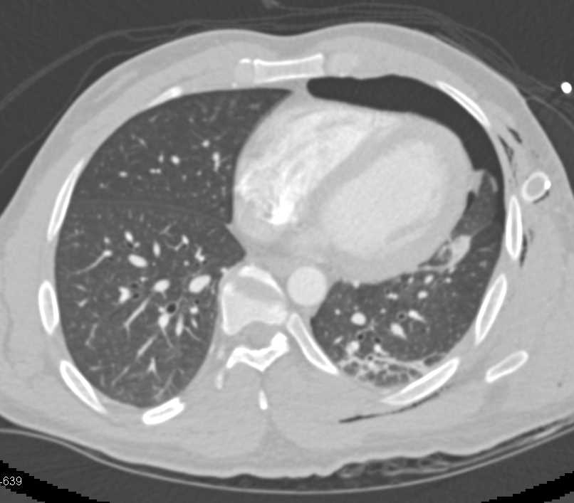 Hypotensive Patient s/p Trauma with Pneumothorax and Femur Fracture - CTisus CT Scan