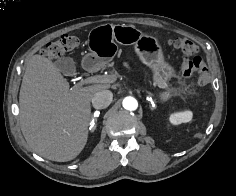 Calcified Adrenal Glands due to Granulomatous Disease - CTisus CT Scan