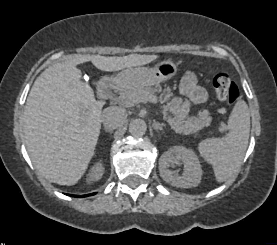 6 mm Left Adrenal Pheochromocytoma - CTisus CT Scan