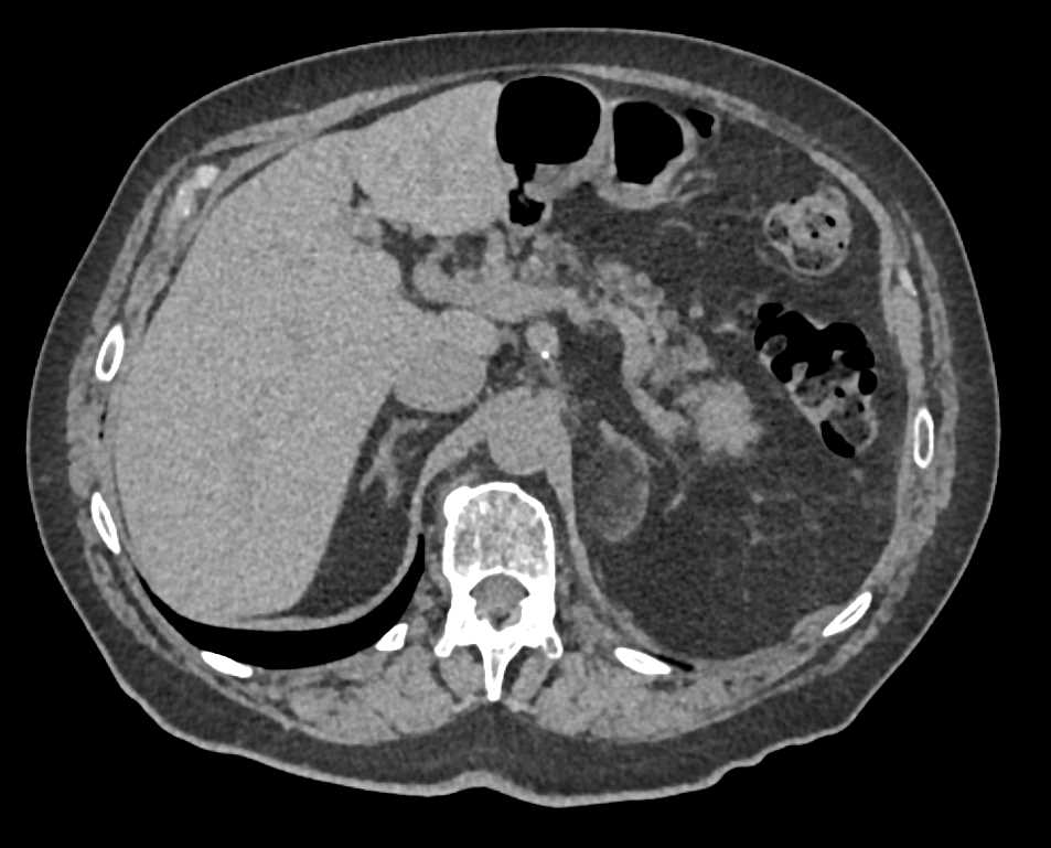 Left Adrenal Myelolipoma - CTisus CT Scan