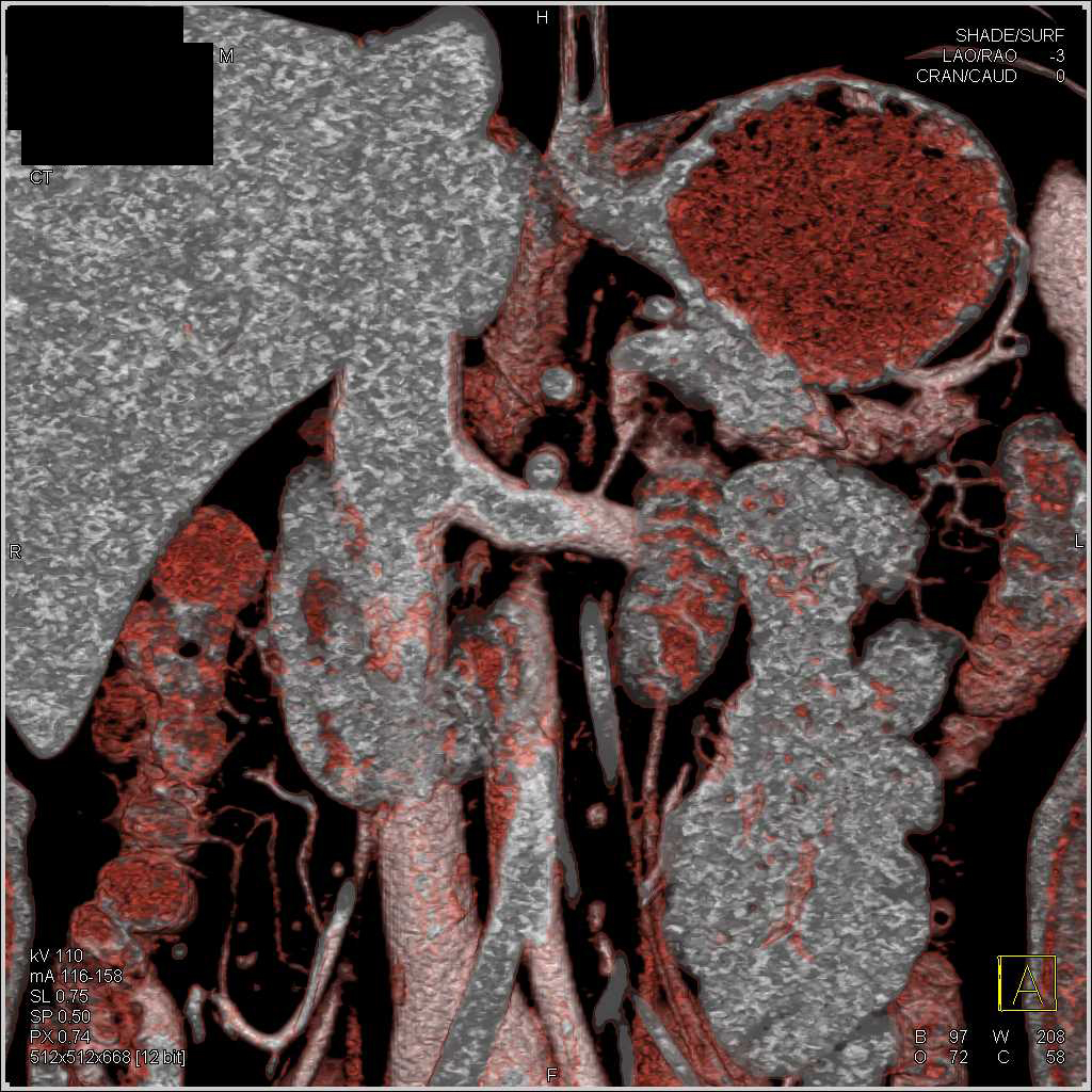 Left Adrenal Vein - CTisus CT Scan