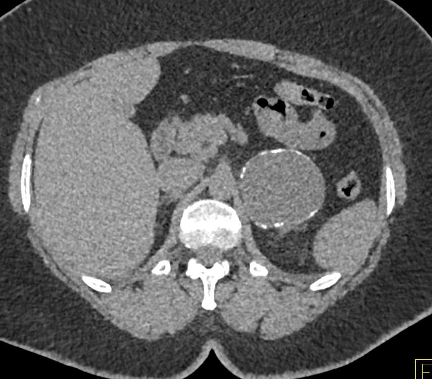 Partially calcified Old Hematoma of the Left Adrenal - CTisus CT Scan
