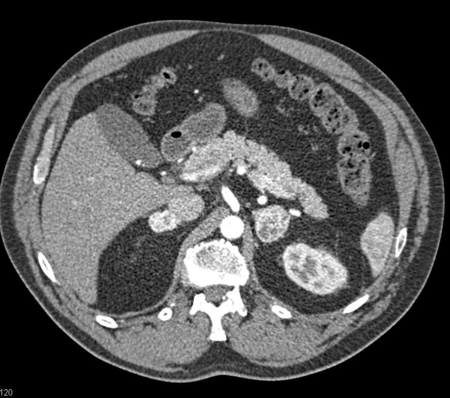 Metastatic Renal Cell Carcinoma of the Adrenals and Contralateral Kidney - CTisus CT Scan