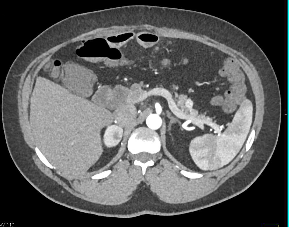 Pheochromocytoma Right Adrenal Gland - CTisus CT Scan