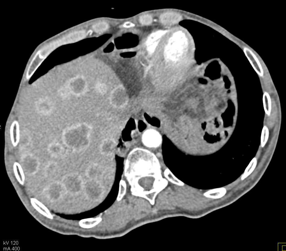 Metastatic Neuroendocrine Tumor to the Liver - CTisus CT Scan