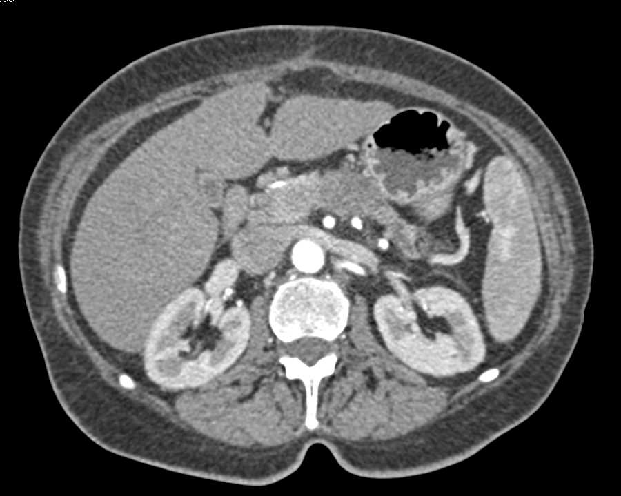 Adenocarcinoma Body of the Pancreas - CTisus CT Scan