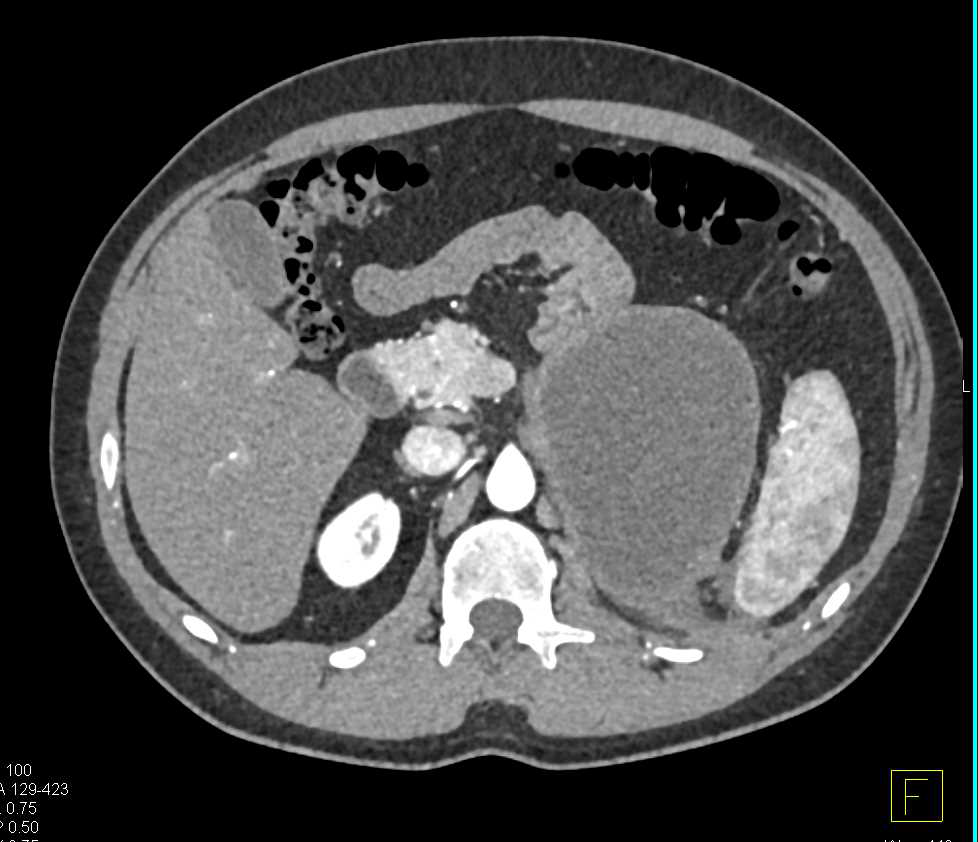 Hematoma Left Adrenal Bed - CTisus CT Scan