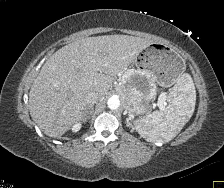 Primary Adrenal Carcinoma - CTisus CT Scan