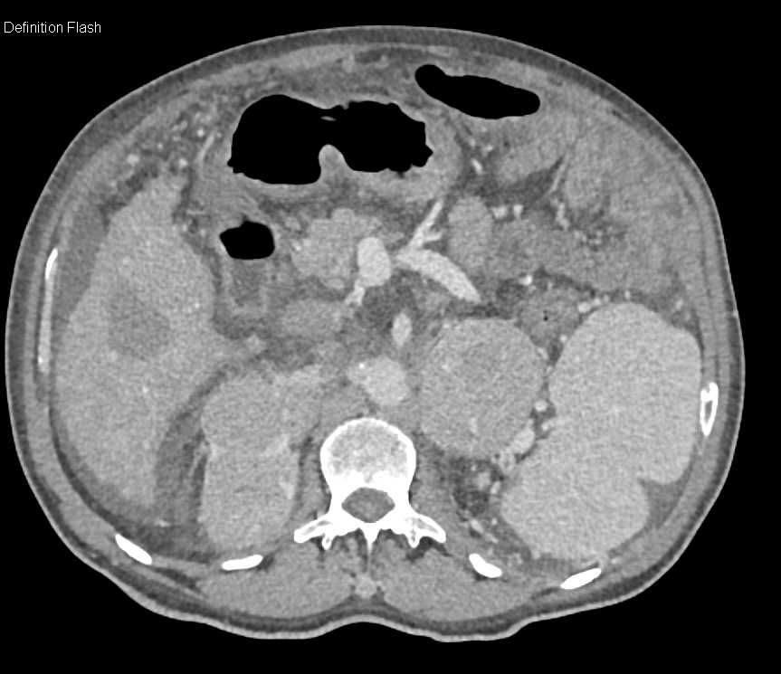 Hepatocellular Carcinoma (Hepatoma) and Bilateral Adrenal Metastases - CTisus CT Scan