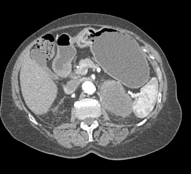 Hypovascular Left Adrenal Pheochromocytoma - CTisus CT Scan