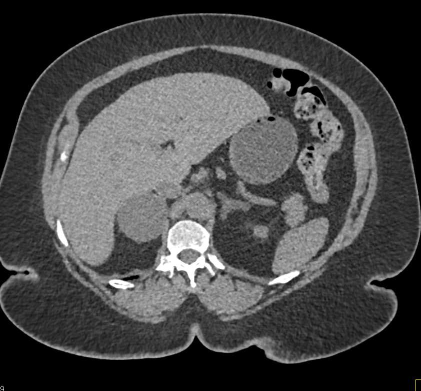Lipid Poor Right Adrenal Adenoma - CTisus CT Scan