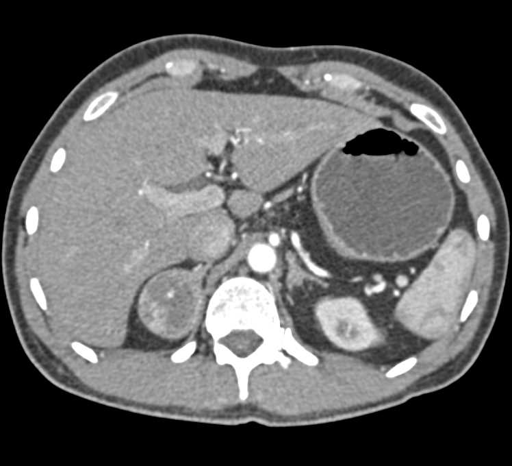 Pheochromocytoma Right Adrenal Gland - CTisus CT Scan