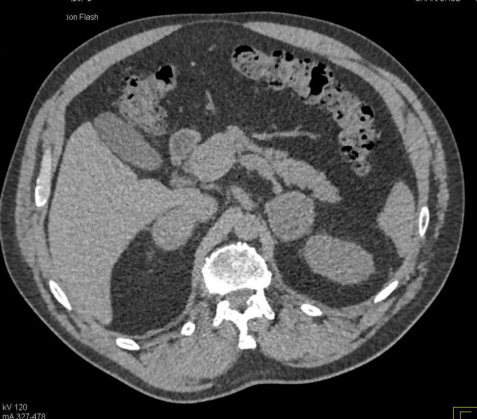 Bilateral Adrenal Metastases form Renal Cell Carcinoma - CTisus CT Scan