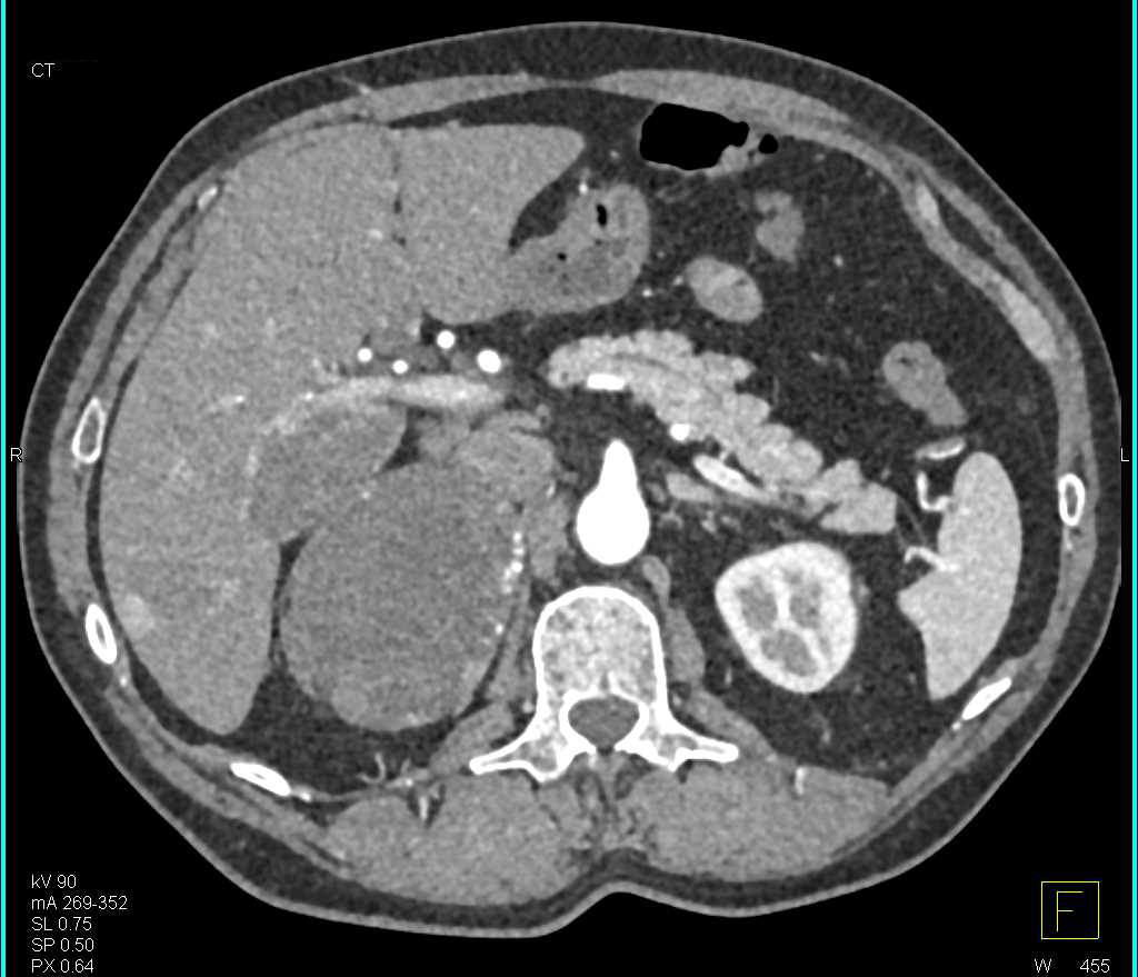Right Adrenal Myelolipoma - CTisus CT Scan