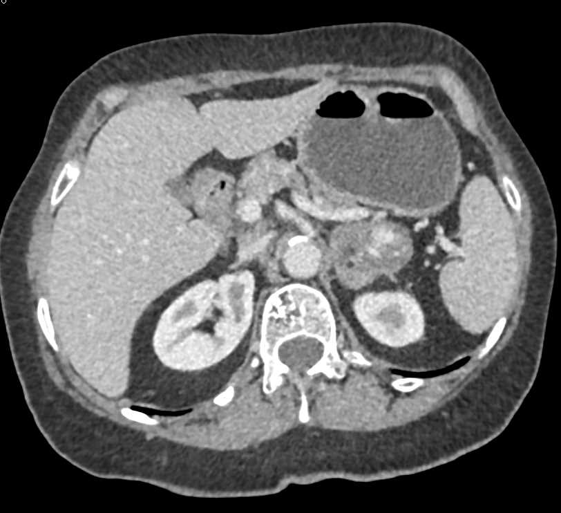 Myelolipoma Left Adrenal Gland - CTisus CT Scan