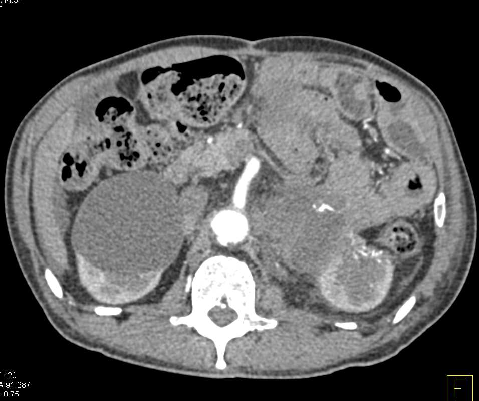 Left Adrenal Carcinoma - CTisus CT Scan