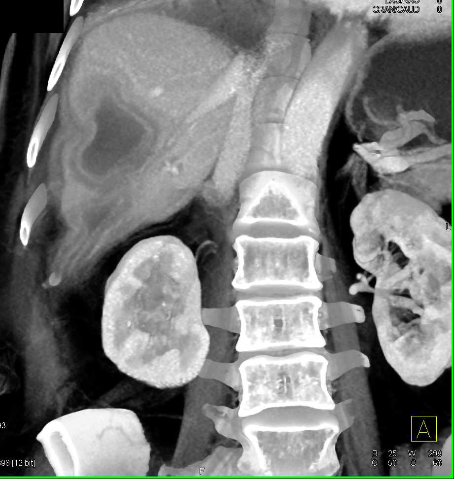 Liver Abscess - CTisus CT Scan