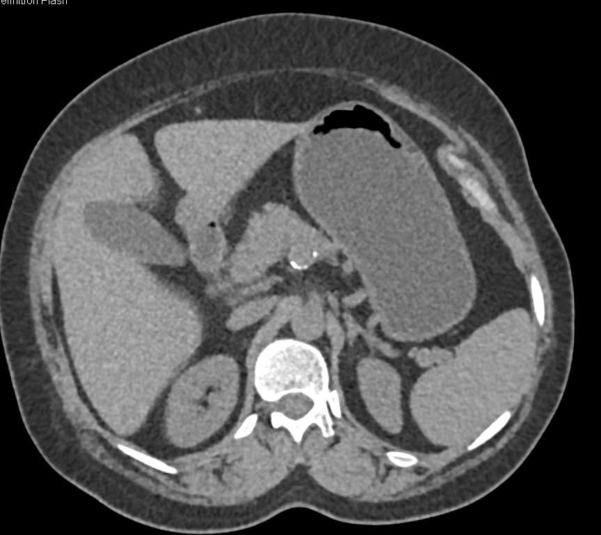 Celiac Artery Aneurysm - CTisus CT Scan