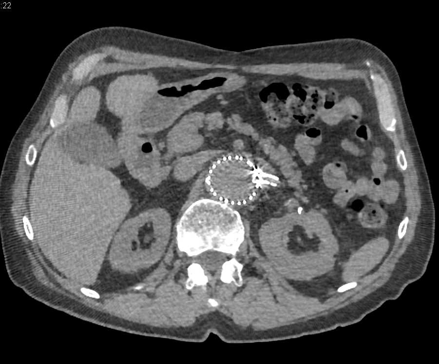 Occluded Stent in Right Renal Artery - CTisus CT Scan