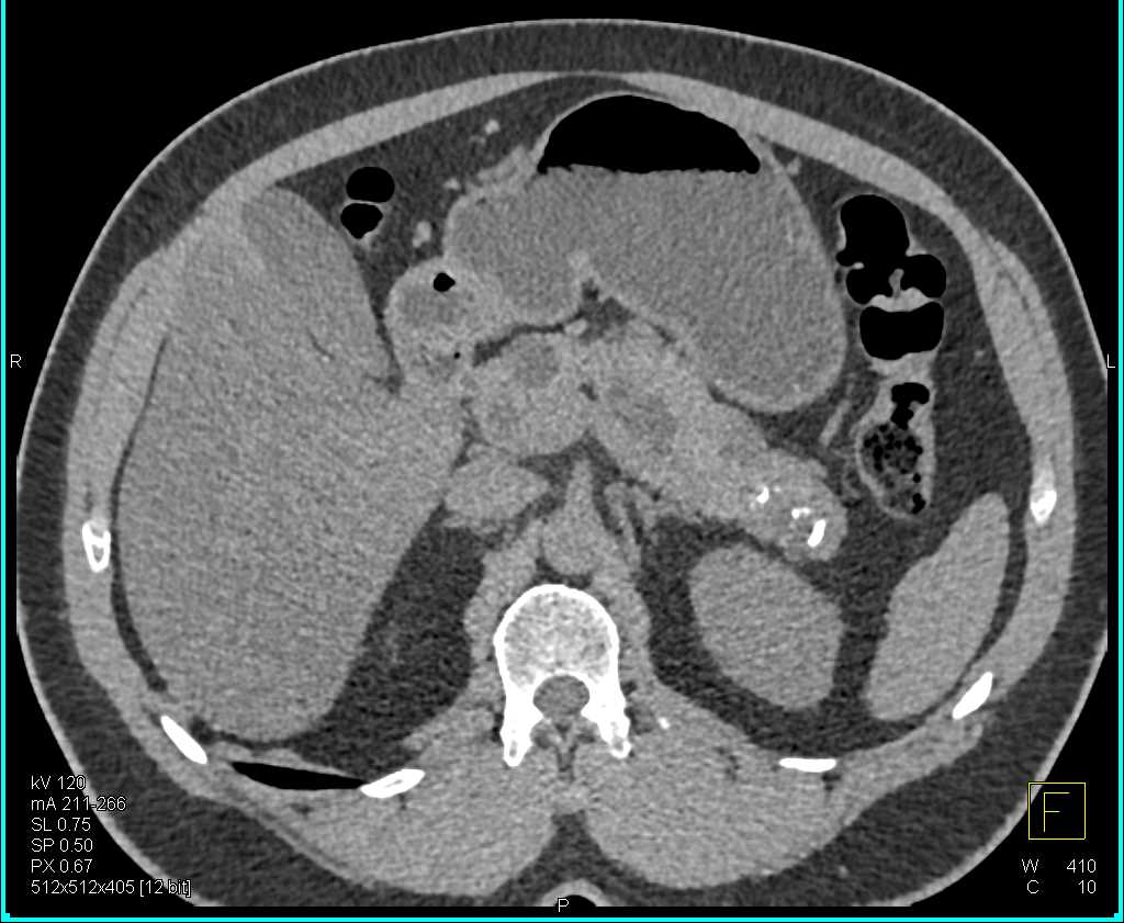Multiple Intraductal Papillary Mucinous Neoplasms (IPMNs) - CTisus CT Scan