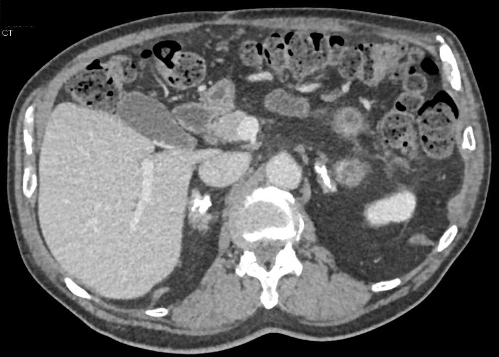 Calcified Adrenal Glands due to Prior Granulomatous Disease - CTisus CT Scan