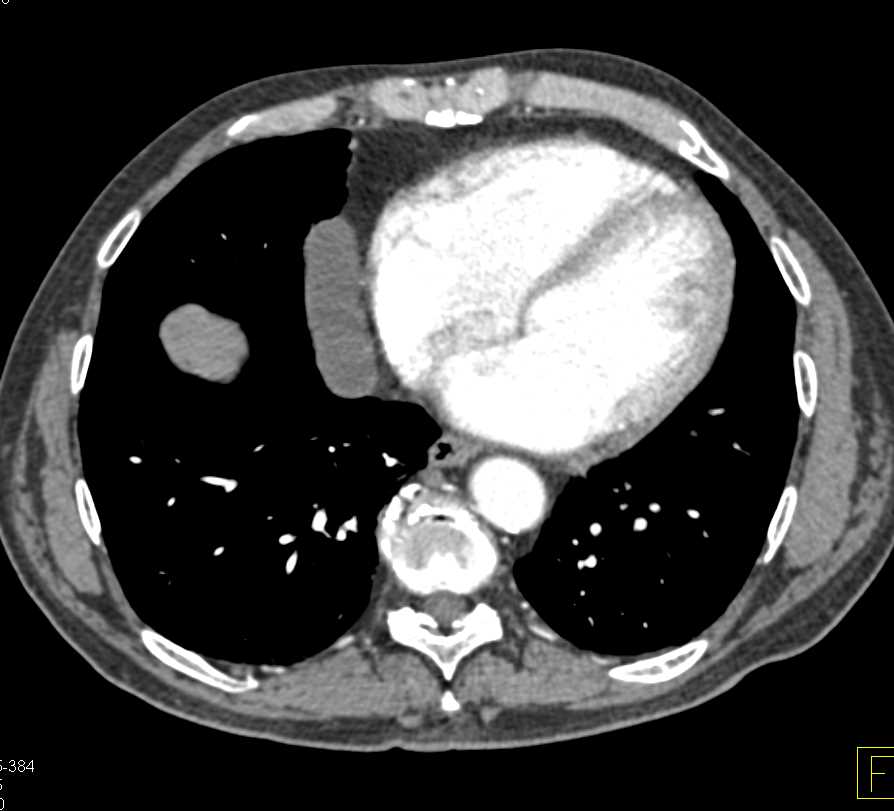 Incidental Pericardial Cyst in Patient with Left Adrenal Pheochromocytoma - CTisus CT Scan