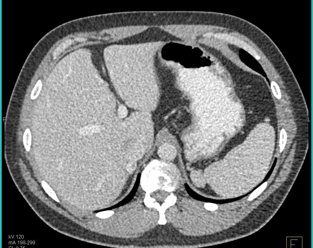 Pheochromocytoma Right Adrenal Gland - CTisus CT Scan