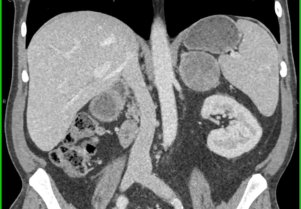 Atypical Adrenal Adenoma - CTisus CT Scan