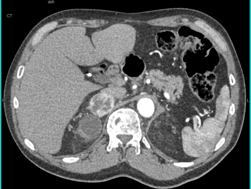Adrenal Metastases from a Previously Resected Clear Cell Renal Cell Carcinoma - CTisus CT Scan