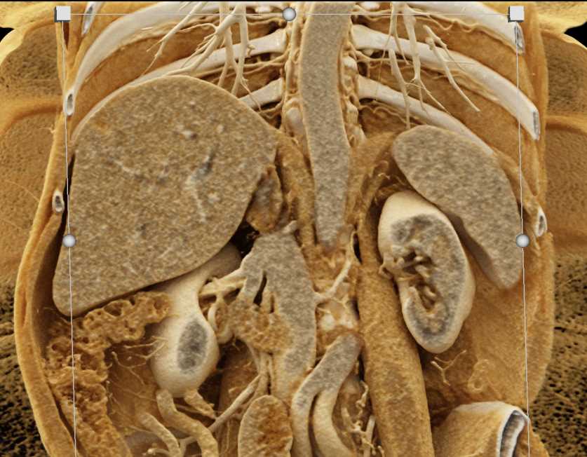 Right Adrenal Adenoma with Cinematic Rendering - CTisus CT Scan