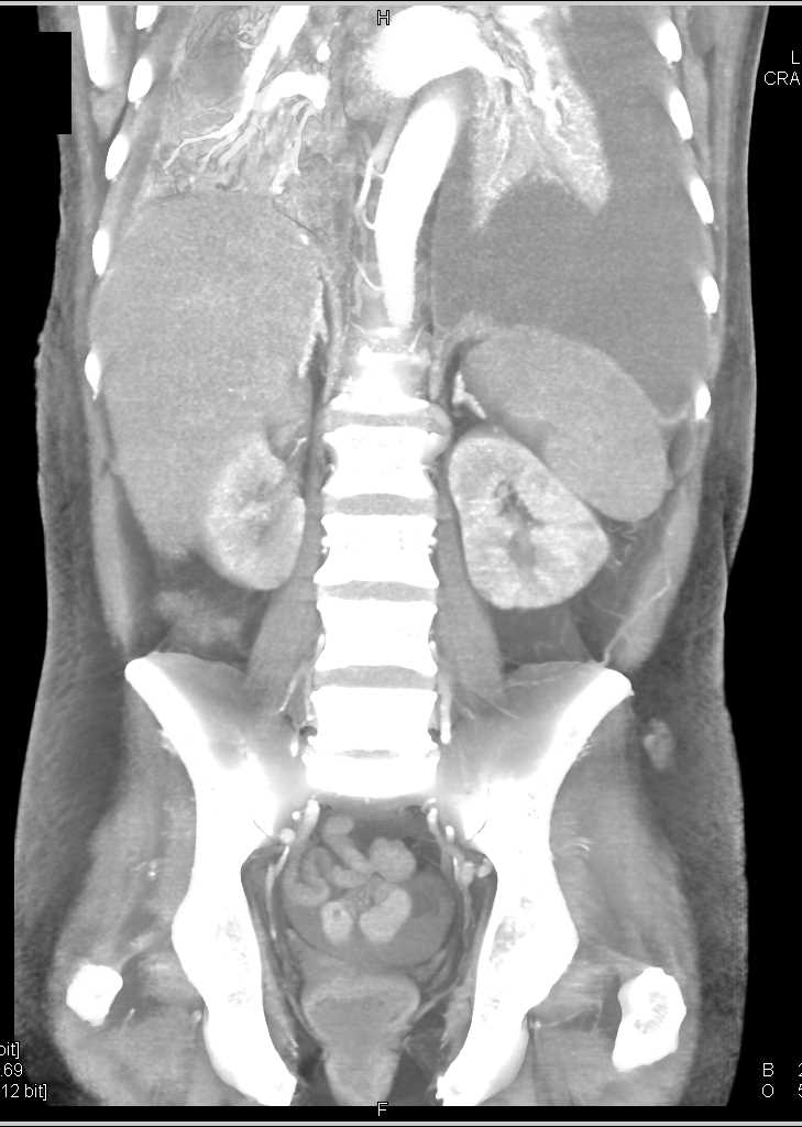 Bright Adrenals in Hypotensive Patient - CTisus CT Scan
