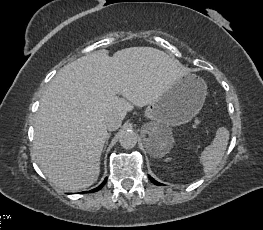 CTisus CT Scanning | Left Adrenal Myelolipoma